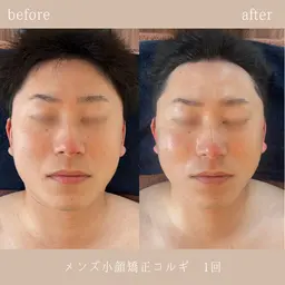 【メンズ☆ミニモ限定🌟】小顔矯正+上半身ほぐし付🉐本場韓国直伝🇰🇷小顔コルギ🔥オイルマッサージ付き🌙