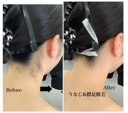 今が始めどき🌻☀️【レディース脱毛】うなじ×襟足