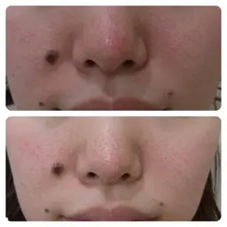 【毛穴の詰まり・黒ずみ・角栓へアプローチ◎】毛穴洗浄コース/肌診断+パックor超音波+リフトアップ+栄養 90分