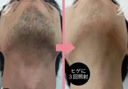 美肌✨メンズヒゲ脱毛➕保湿パック付き💎鼻下~首
