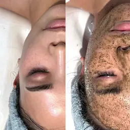 【人気No.1】話題の肌育成ハーブピーリング［全顔］🌿一回でも効果実感✨※翌日以降メイク可能