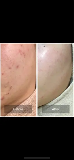 ハーブピーリング🌿剥離あり、なし+ハイドラフェイシャル(毛穴洗浄) フェイシャルエステ 毛穴の汚れ 黒ずみ ニキビ