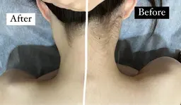 🦋うなじ脱毛+背中脱毛🦋