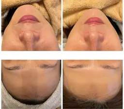 光フェイシャル