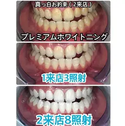 【初回限定・白さを極める】真っ白お約束🦷プレミアムホワイトニング❣️〈合計8回照射2来店〉❣️😌✨