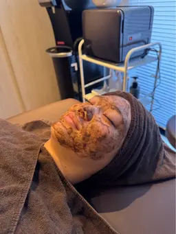 【ご新規様🉐】ハーブピーリング🌼剥離なし‼️当日メイクOK🎀特別な前日などに✨️¥13,200-