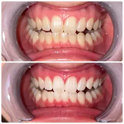 【平日18時迄】🎈口コミ限定クーポン🎈15分×2回照射　8800円→1100円🧡