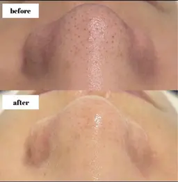 ハイドラフェイシャル(毛穴洗浄)   鼻周りのみのため全顔希望の方はお申し付けください✨