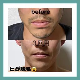 メンズ　髭脱毛🥸
