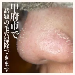 【マッサージ無し】毛穴エクストラクション選べる1部位(鼻,両頬,アゴ,額)