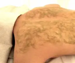 ✨ドレス映え・夏前のケアに✨背中ニキビ徹底ケア🌿【OHLハーブピーリング🕐60】+酵素ピーリングケア