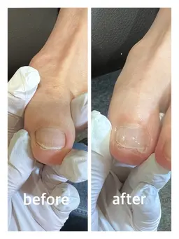 ⭐️全員クーポン⭐️巻き爪【陥入爪】                                   ¥8,800