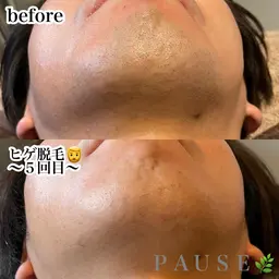 🥸メンズ脱毛🥸ひげALLセット一回コース