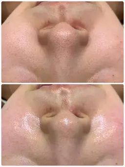 人気のピーリング&細胞活性美容液導入&マッサージ❤️美白/小顔/毛穴ケア🫧肌リセット+肌育✨