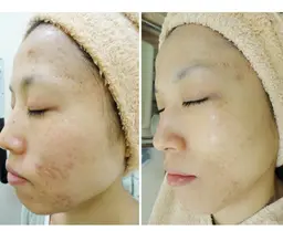 ニキビ、ニキビ跡、クレーターのお悩みの方へ　結果重視❗メンズ大歓迎✨