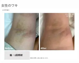 🖤ミニモ限定🥀 脇脱毛🌸