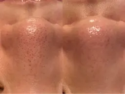 ミニモ初回限定価格!【結果重視】毛穴徹底洗浄×吸引×鎮静ケア※鼻のみ