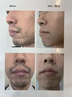 メンズ顔、ひげまとめて 何度でも1回3000円‼︎👨👑✨