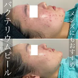 【ニキビ肌変えたい方向け🌷】バクテリウムピール4回コース+ホームケア用クレンジング付き✨メンズOK🙆♀️