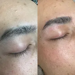 ヒゲ脱毛＋HBL（ハリウッドブロウリフト）