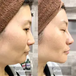 韓国風コルギ(小顔矯正)