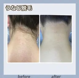 🍯脱毛デビュー必見🍯うなじ、背中（熱破壊式）脱毛✨実績40年のレイビス。シェービング付き👍🏻✨