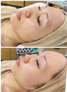 水光肌ピーリング