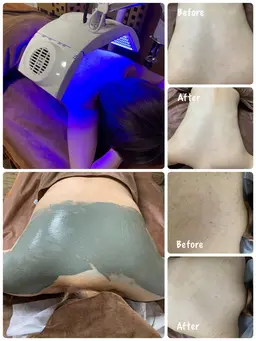 【ボディケア】3色ブレンドLED照射&ボディケアパック✨背中・二の腕・デコルテ・お尻のニキビやザラザラ感、くすみのケアに