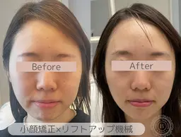 【人気No.2】とにかく小顔に特化♪小顔矯正×強力EMS×リフトアップ機械¥22000→