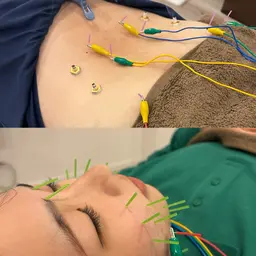 【人気急上昇】顔も身体も整う♪美容鍼灸+鍼灸+整体の本格ケア