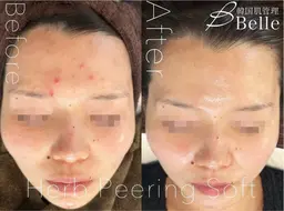 ハーブピーリング+アクネ菌殺菌