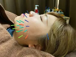 【美容鍼🪡✨️】