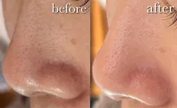 【毛穴改善小顔コース】毛穴洗浄→角質除去→美容液導入→マッサージ→パック