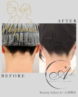 【ひげうな脱毛】口周り+うなじ！即冷却の痛み軽減脱毛🌈ムダ毛脱毛でストレスフリーに🌟（都度払いOK脱毛）