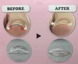 巻き爪矯正👣ペディバランス(ジェルネイル)使用✨10指爪切り甘皮ケア(¥4900のコース)+巻き爪矯正1本✨