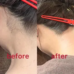 ミニモ限定【うなじツルスベワックス脱毛&最新THR光脱毛】メンズOK！