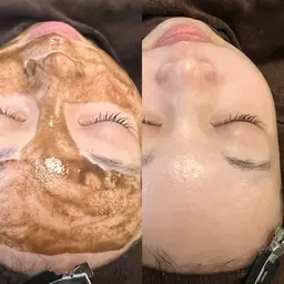 【ミニモ限定💫】ハーブピーリング🌿