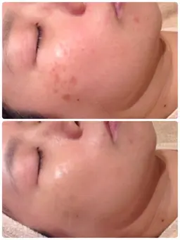 シミケア🖊️ご新規様限定