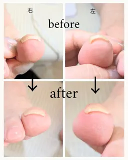 【フット】巻き爪が広がる！特殊ジェル(クリア)