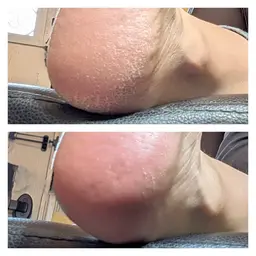 フット角質ケア