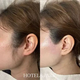 【もみあげワックス脱毛】