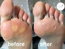 トータル角質ケア　魚の目個数制限なし　(魚の目・タコ・かかと足裏全体ケアします)※初めての方にオススメ