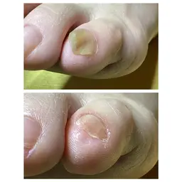 【フットネイルケア】足の爪が分厚い・割れ・二枚爪・変形した爪の専門ケア