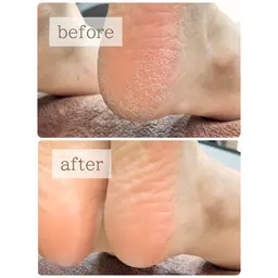 ⭐️フット角質取り-素足美人コース⭐️