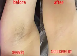 福山希少LED脱毛（顔・VIO込み）女性のみ【効果が出やすい脱毛！痛くない！】