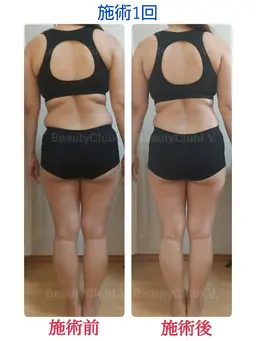 【結果重視】痩身エステ～筋膜リリース～