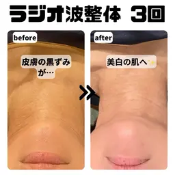 【初回限定35%OFF】 ラジオ波小顔矯正💆♀️たるみ/ゆがみ/むくみ/しわ/肌荒れ【小顔/デコルテ/首/頭】