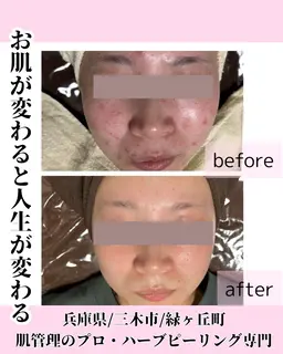 本気のハーブピーリング選べる(剥離あり、なし)肌質改善Ｎｏ．1