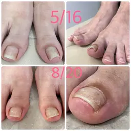 巻き爪 解放 2指（両足親指）