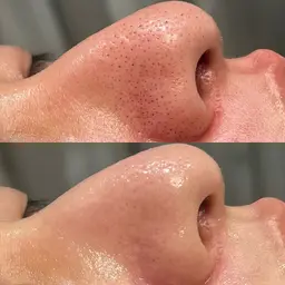 フルフェイスワックス顔脱毛×鼻のみ毛穴洗浄×贅沢パック⭕️